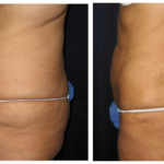 Smartlipo_BeforeAfter_00