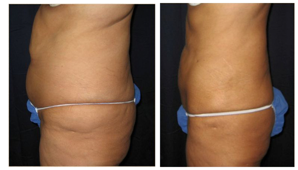 Smartlipo BeforeAfter 00 Some SmartLipo Before and After Images