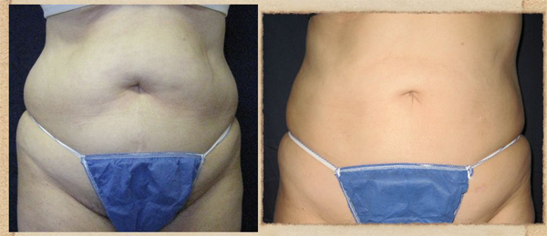 Smartlipo BeforeAfter 02 Some SmartLipo Before and After Images
