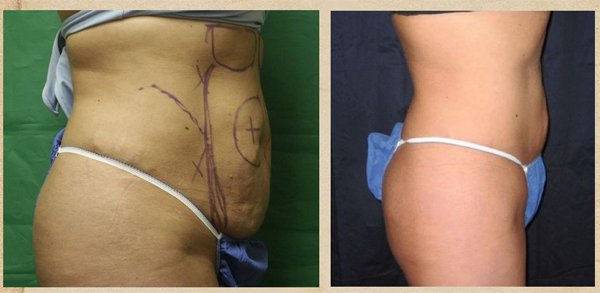 Smartlipo BeforeAfter 03 Some SmartLipo Before and After Images